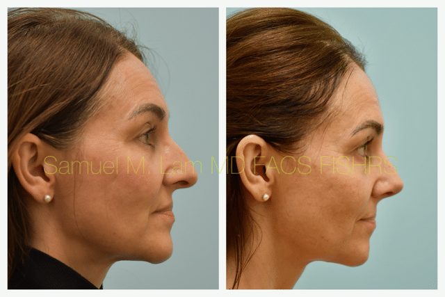 Rhinoplasty Before and After Photo by Dr. Lam in Plano TX Rhinoplasty Before and After Photo by Dr. Lam in Plano TX