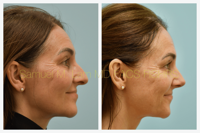 Rhinoplasty Before and After Photo by Dr. Lam in Plano TX Rhinoplasty Before and After Photo by Dr. Lam in Plano TX