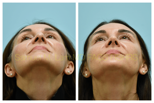 Rhinoplasty Before and After Photo by Dr. Lam in Plano TX Rhinoplasty Before and After Photo by Dr. Lam in Plano TX