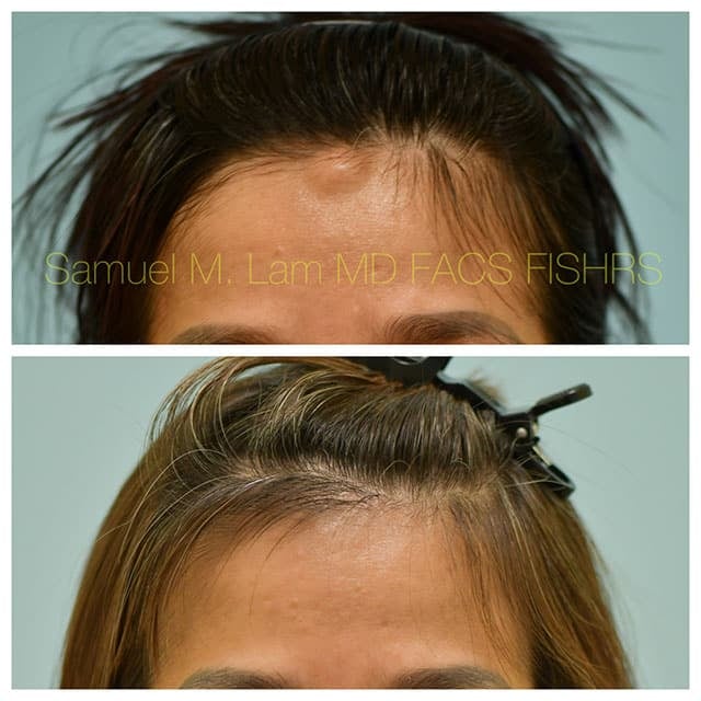 Osteoma Before and After Photo by Dr. Lam in Plano TX Osteoma Before and After Photo by Dr. Lam in Plano TX