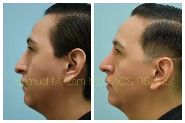 Rhinoplasty Before and After Photo by Dr. Lam in Plano TX