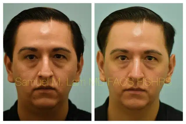Rhinoplasty Before and After Photo by Dr. Lam in Plano TX