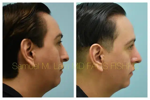 Rhinoplasty Before and After Photo by Dr. Lam in Plano TX