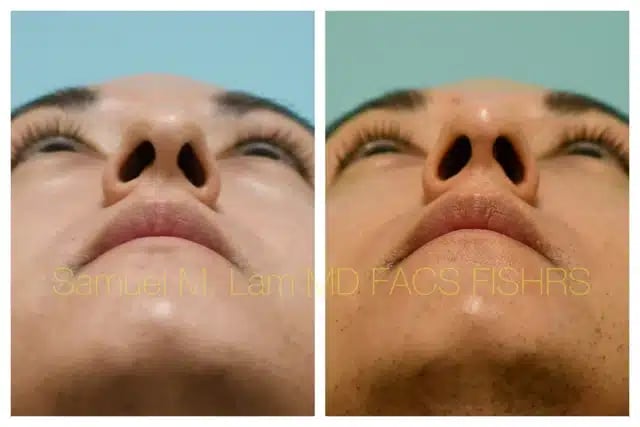 Rhinoplasty Before and After Photo by Dr. Lam in Plano TX