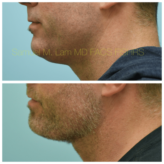 Facelift Before and After Photo by Dr. Lam in Plano TX Facelift Before and After Photo by Dr. Lam in Plano TX
