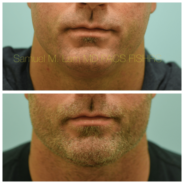 Facelift Before and After Photo by Dr. Lam in Plano TX Facelift Before and After Photo by Dr. Lam in Plano TX