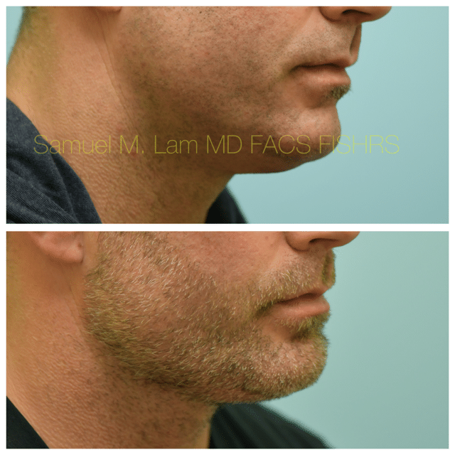Facelift Before and After Photo by Dr. Lam in Plano TX Facelift Before and After Photo by Dr. Lam in Plano TX