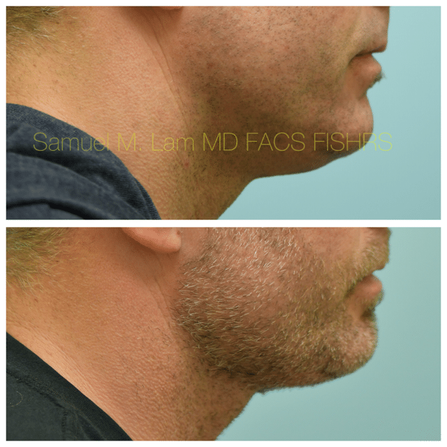 Facelift Before and After Photo by Dr. Lam in Plano TX Facelift Before and After Photo by Dr. Lam in Plano TX