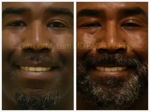 Lip Reduction Before and After Photo by Dr. Lam in Plano TX