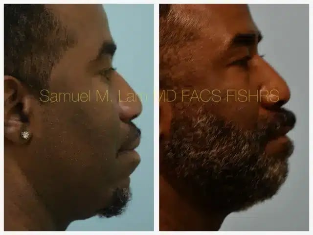 Lip Reduction Before and After Photo by Dr. Lam in Plano TX