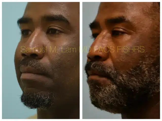 Lip Reduction Before and After Photo by Dr. Lam in Plano TX