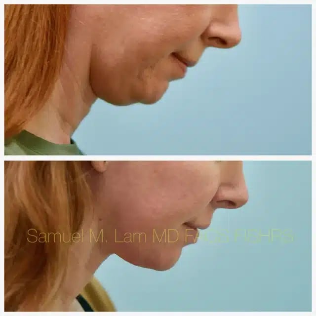 Facelift Before and After Photo by Dr. Lam in Plano TX
