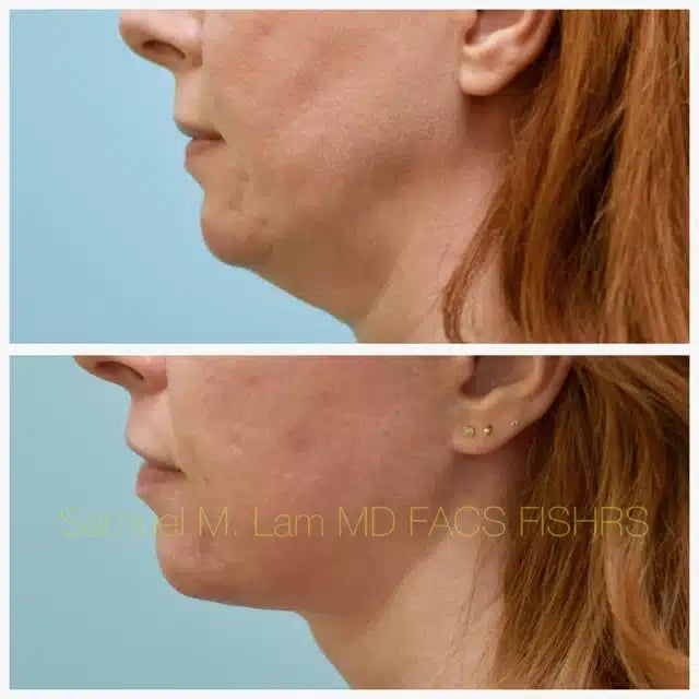 Facelift Before and After Photo by Dr. Lam in Plano TX