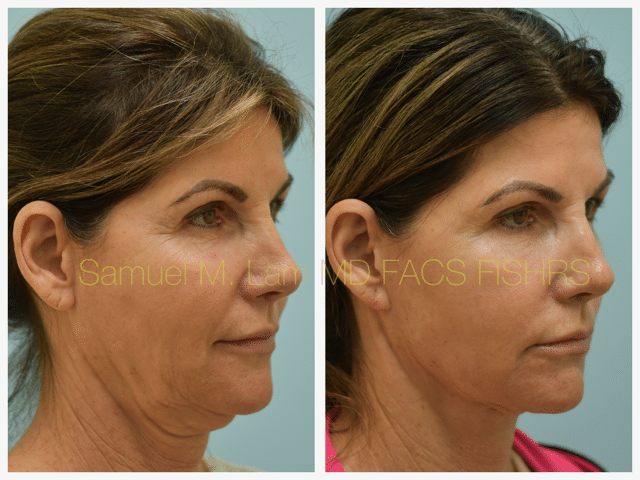 Fat Grafting and Facelift Before and After Photo by Dr. Lam in Plano TX