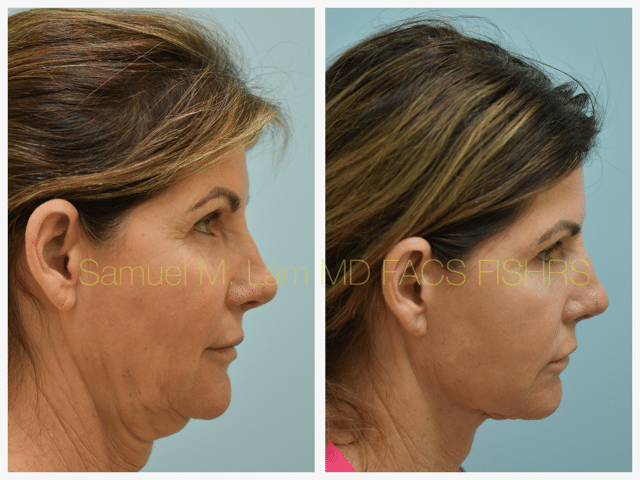 Fat Grafting and Facelift Before and After Photo by Dr. Lam in Plano TX