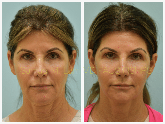 Fat Grafting and Facelift Before and After Photo by Dr. Lam in Plano TX