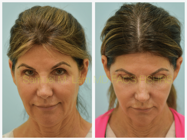 Fat Grafting and Facelift Before and After Photo by Dr. Lam in Plano TX