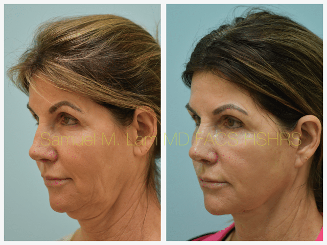 Fat Grafting and Facelift Before and After Photo by Dr. Lam in Plano TX