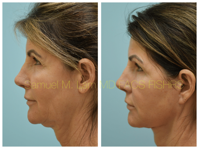 Fat Grafting and Facelift Before and After Photo by Dr. Lam in Plano TX