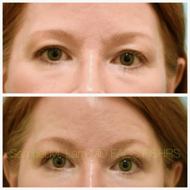 Fat Grafting and Blepharoplasty Before and After Photo by Dr. Lam in Plano TX Fat Grafting and Blepharoplasty Before and After Photo by Dr. Lam in Plano TX