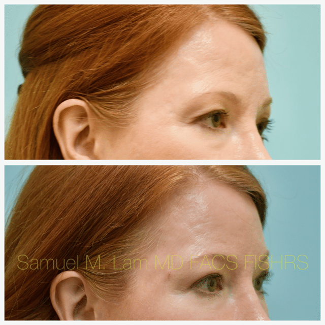 Fat Grafting and Blepharoplasty Before and After Photo by Dr. Lam in Plano TX Fat Grafting and Blepharoplasty Before and After Photo by Dr. Lam in Plano TX
