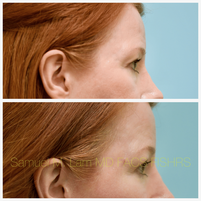 Fat Grafting and Blepharoplasty Before and After Photo by Dr. Lam in Plano TX Fat Grafting and Blepharoplasty Before and After Photo by Dr. Lam in Plano TX