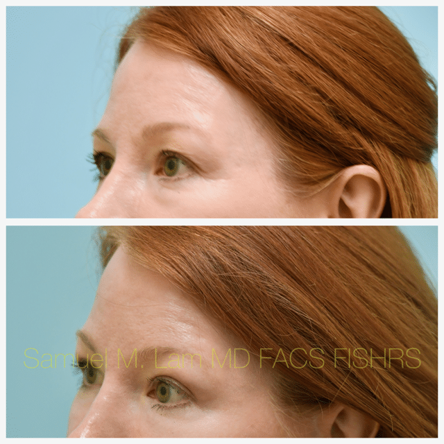 Fat Grafting and Blepharoplasty Before and After Photo by Dr. Lam in Plano TX Fat Grafting and Blepharoplasty Before and After Photo by Dr. Lam in Plano TX