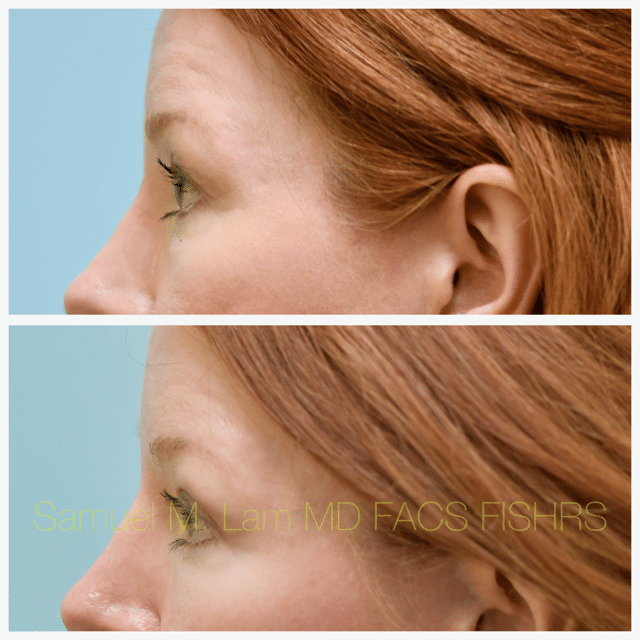 Fat Grafting and Blepharoplasty Before and After Photo by Dr. Lam in Plano TX Fat Grafting and Blepharoplasty Before and After Photo by Dr. Lam in Plano TX