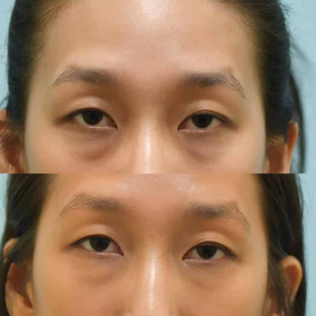 blepharoplasty before and after photo by sam lam patient blepharoplasty before and after photo by sam lam patient