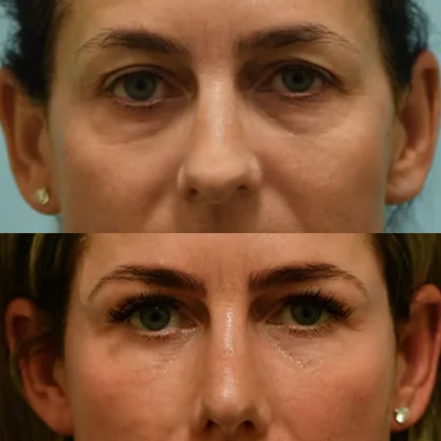 blepharoplasty before and after photo by sam lam patient blepharoplasty before and after photo by sam lam patient
