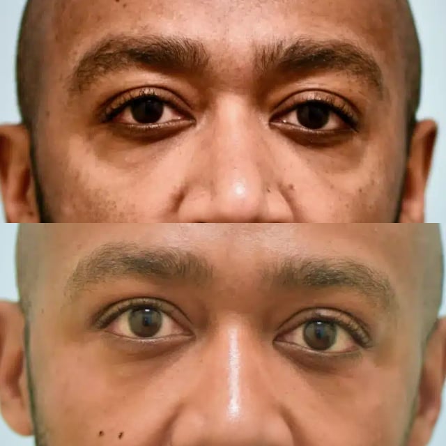 blepharoplasty before and after photo by sam lam patient blepharoplasty before and after photo by sam lam patient
