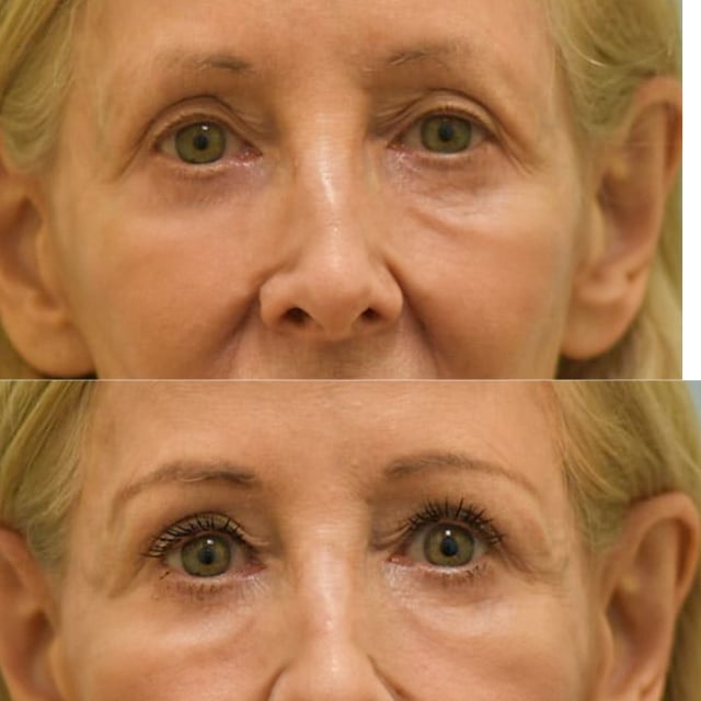 blepharoplasty before and after photo by sam lam patient blepharoplasty before and after photo by sam lam patient