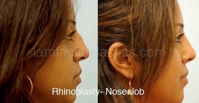 Rhinoplasty Before and After Photo by Dr. Lam in Plano TX