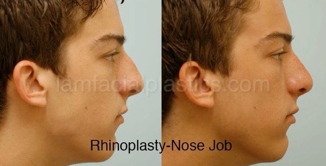 Rhinoplasty Before and After Photo by Dr. Lam in Plano TX