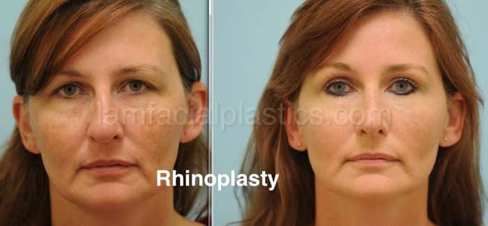 Rhinoplasty Before and After Photo by Dr. Lam in Plano TX