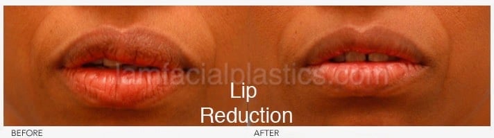 lip reduction bxa lip reduction bxa