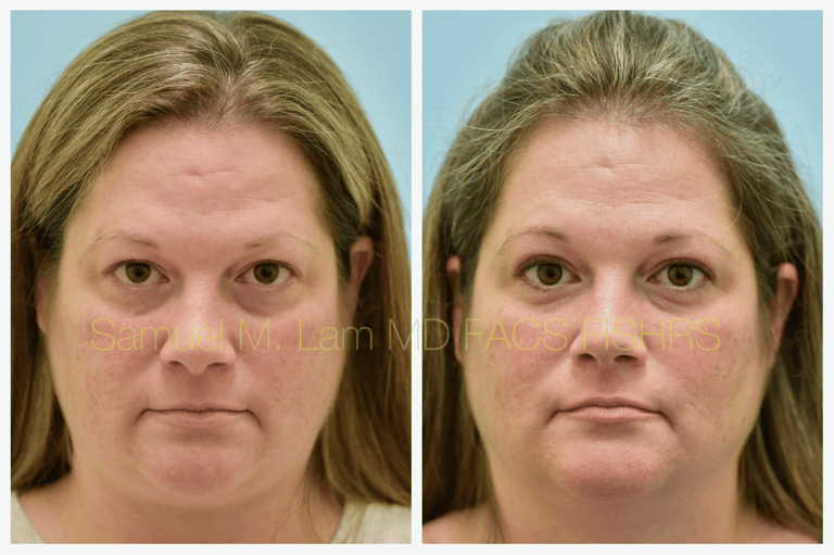blepharoplasty before and after blepharoplasty before and after