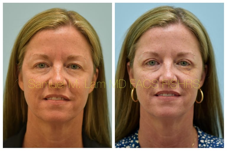 Blepharoplasty Before and After Photo - Dr. Sam Lam - Dallas, TX Blepharoplasty Before and After Photo - Dr. Sam Lam - Dallas, TX