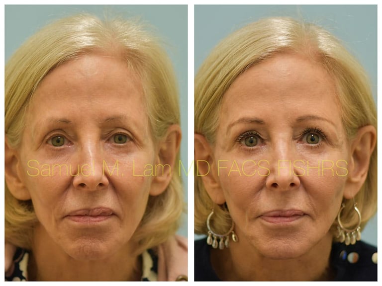 Eyelid Before and After Photo by Dr. Lam in Plano TX Eyelid Before and After Photo by Dr. Lam in Plano TX