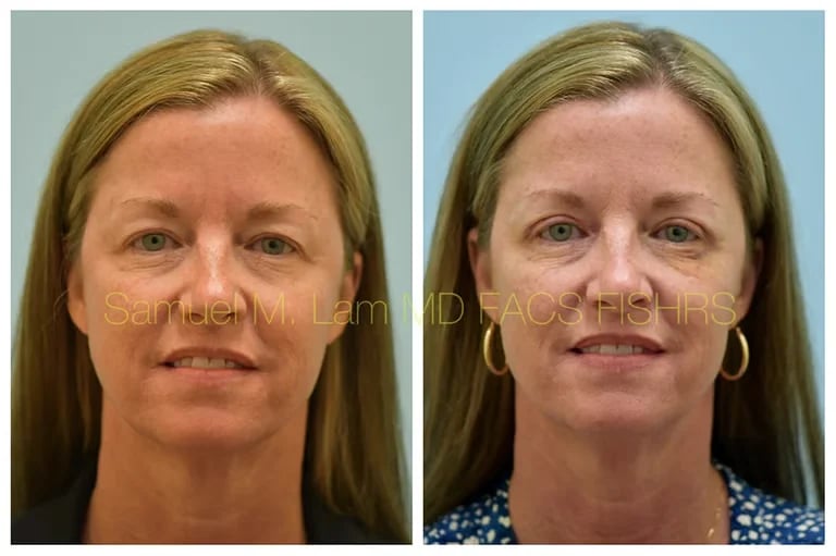 eyelid lift before and after dallas Before and after blepharoplasty results on middle-aged woman.