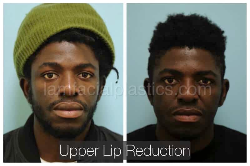 lip reduction bxa lip reduction bxa