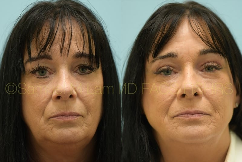 Eyelid Rejuvenation Eyelid Rejuvenation