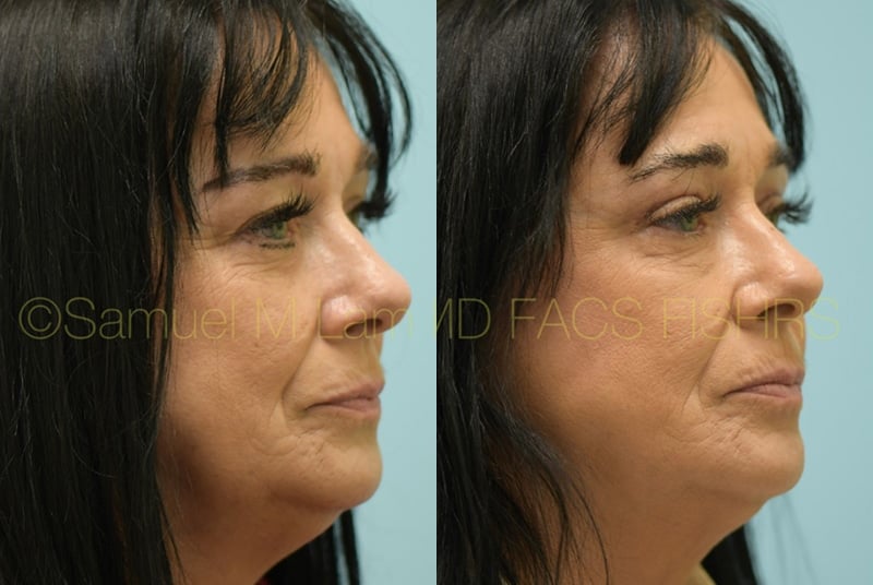 Eyelid Rejuvenation Eyelid Rejuvenation