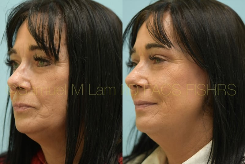Eyelid Rejuvenation Eyelid Rejuvenation