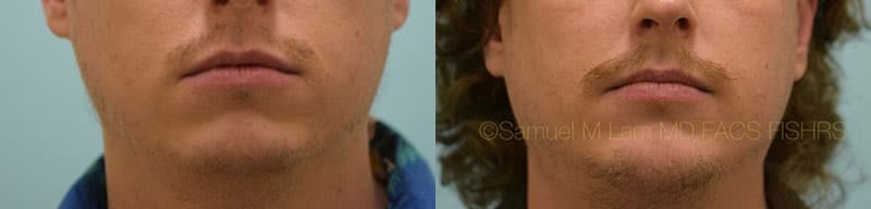 Chin Augmentation Chin Augmentation