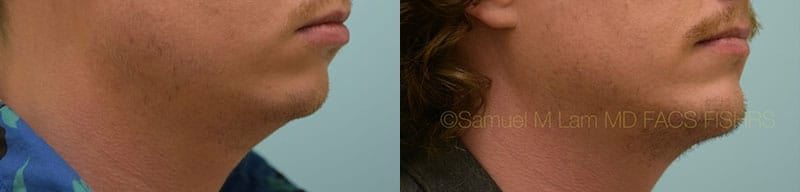 Chin Augmentation Chin Augmentation