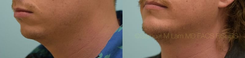 Chin Augmentation Chin Augmentation