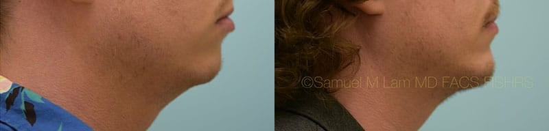 Chin Augmentation Chin Augmentation