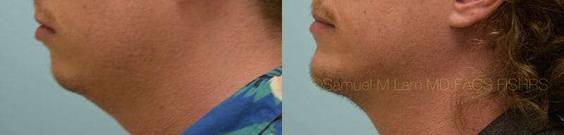 Chin Augmentation Chin Augmentation