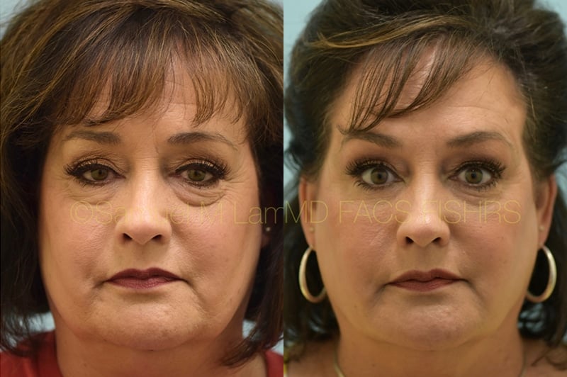 Eyelid Rejuvenation, Fat Grafting Eyelid Rejuvenation, Fat Grafting